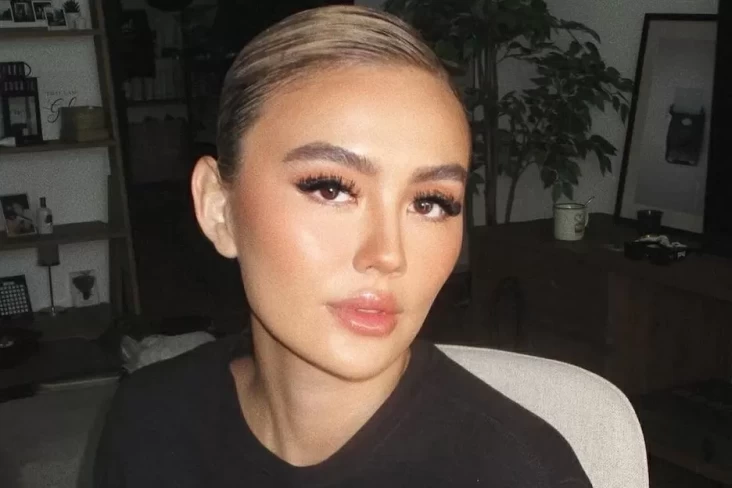 Mengenal Alopecia Areata, Penyakit yang yang dimaksud Menjangkit Agnez Mo hingga Alami Kebotakan