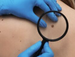 Kenali Neurofibromatosis Tipe 1, Penyakit Langka Serang Jaringan Saraf