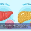 Cara Modern Menjalani Hidup Sehat agar Terhindar dari Fatty Liver Tanpa Perubahan yang Berlebihan