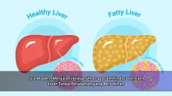 Cara Modern Menjalani Hidup Sehat agar Terhindar dari Fatty Liver Tanpa Perubahan yang Berlebihan